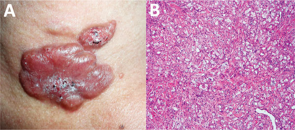 Skin biopsy distinguishes cutaneous leishmaniasis from lobomycosis in Colombian soldiers